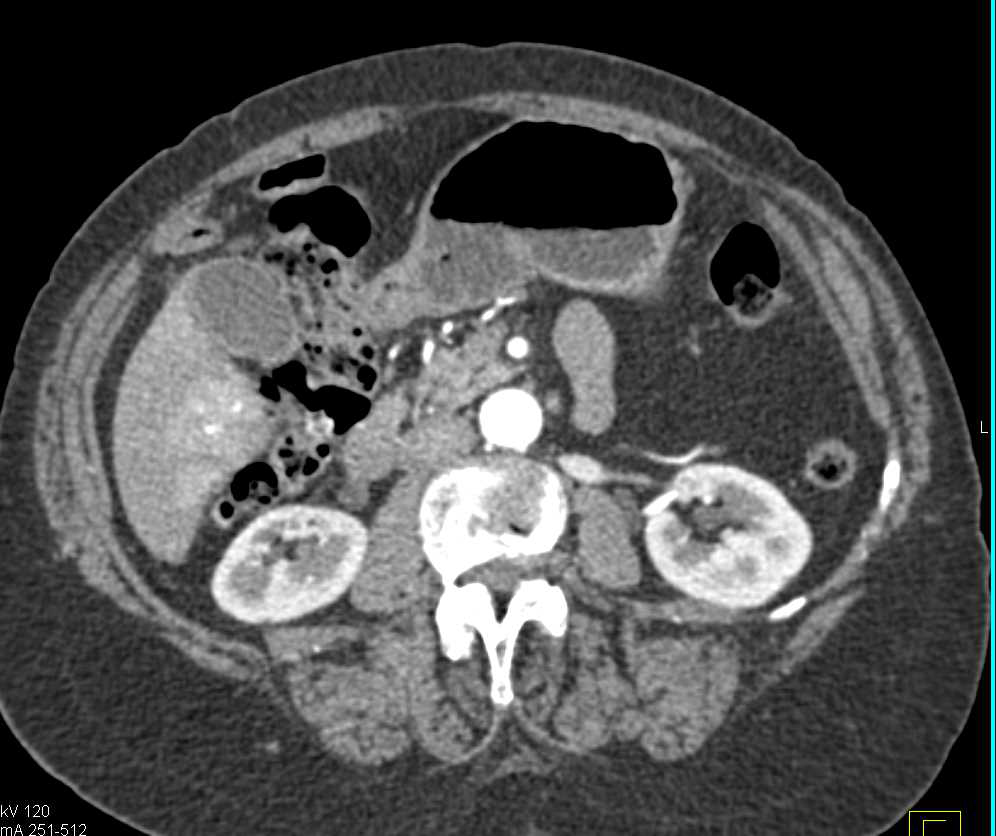 Flash Filling Hemangioma Right Lobe of the Liver - CTisus CT Scan