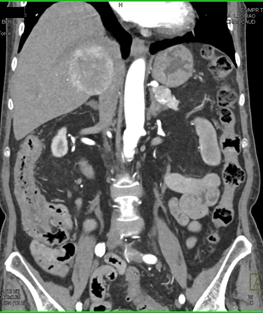 Hepatoma with Neovascularity - CTisus CT Scan
