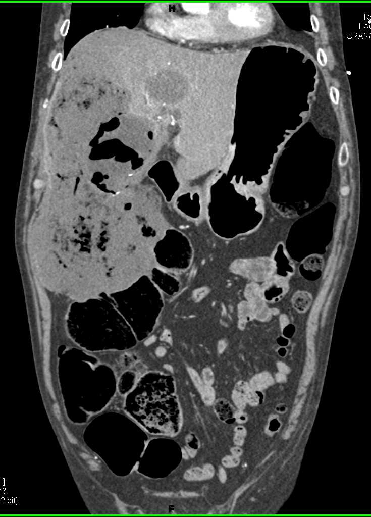 Liver Infarct with Abscess - CTisus CT Scan
