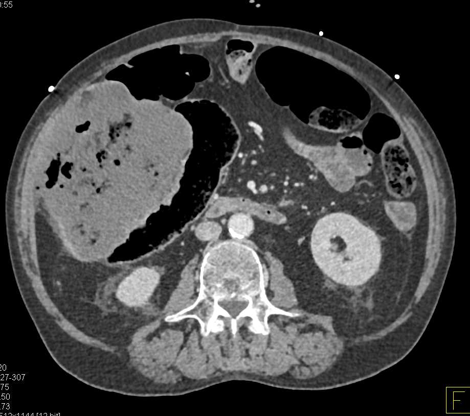 Hepatic Necrosis and Infarction - CTisus CT Scan