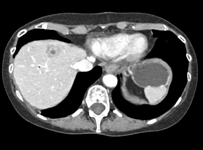 Liver Metastases in Pancreatic Cancer - CTisus CT Scan