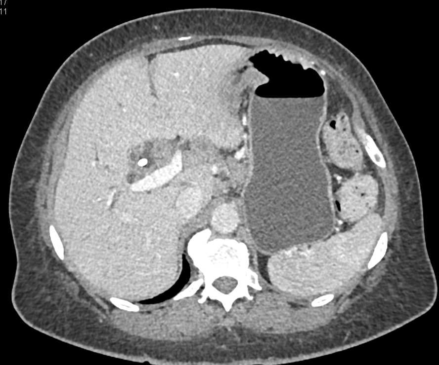 Biliary Tumor with Enlarged Nodes in the Porta Hepatitis - CTisus CT Scan