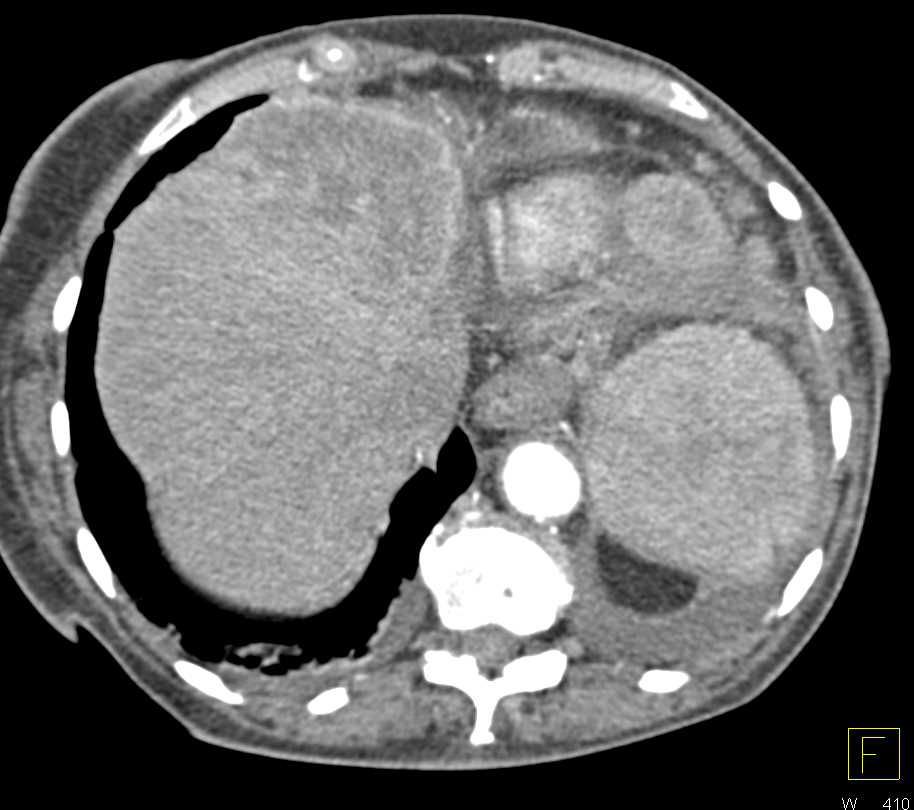 Hepatoma Invades the Diaphragm - CTisus CT Scan