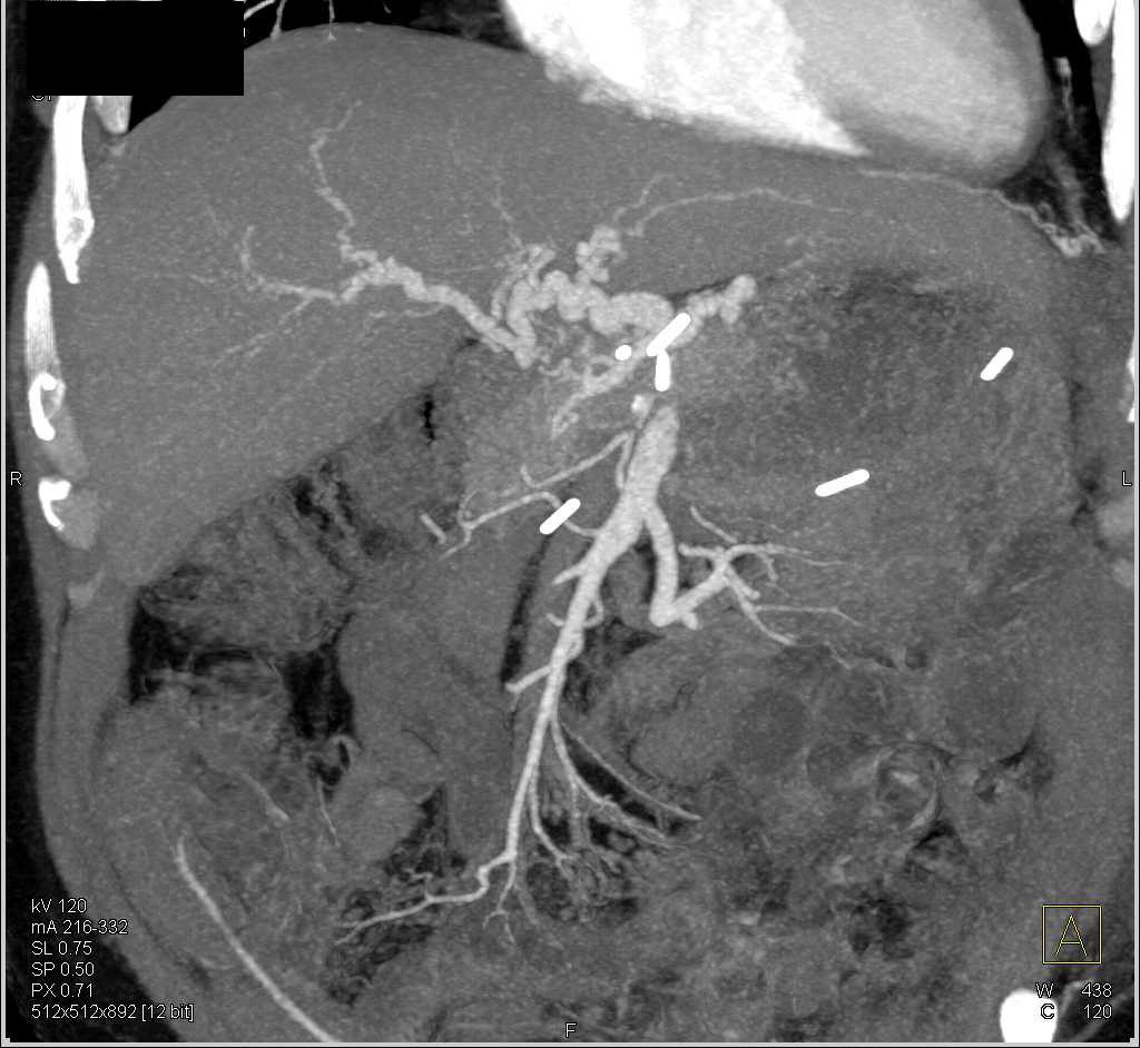 Cirrhosis with Irregular Hepatic Artery - CTisus CT Scan