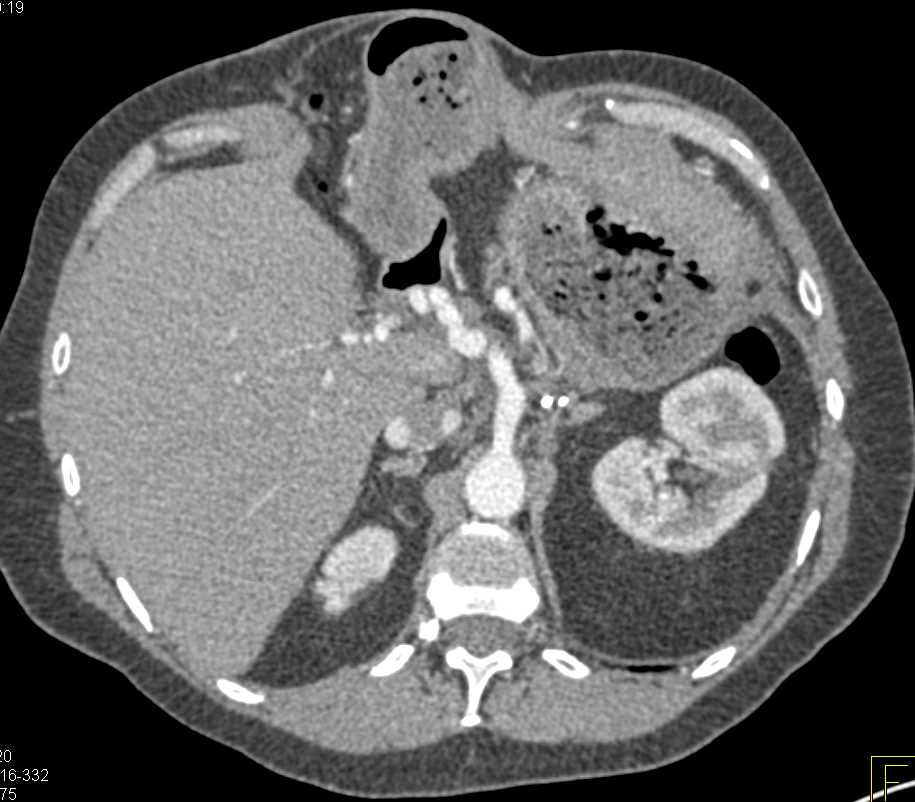 Cirrhosis with Irregular Hepatic Artery - CTisus CT Scan