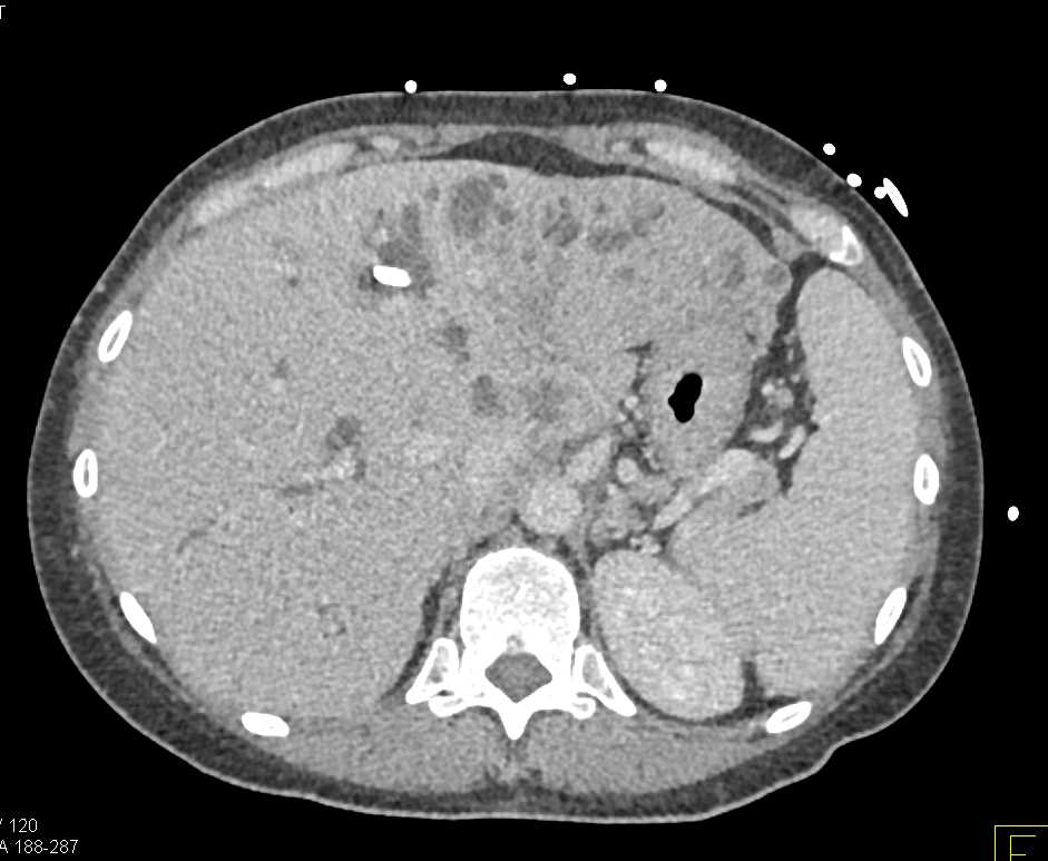 Central Cholangiocarcinoma with Tumor Spread - CTisus CT Scan