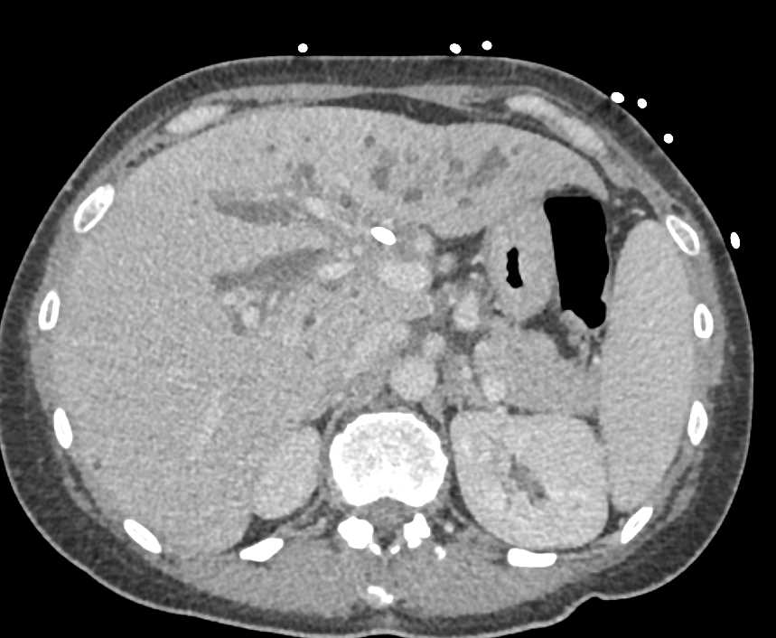 Central Cholangiocarcinoma with Tumor Spread - CTisus CT Scan