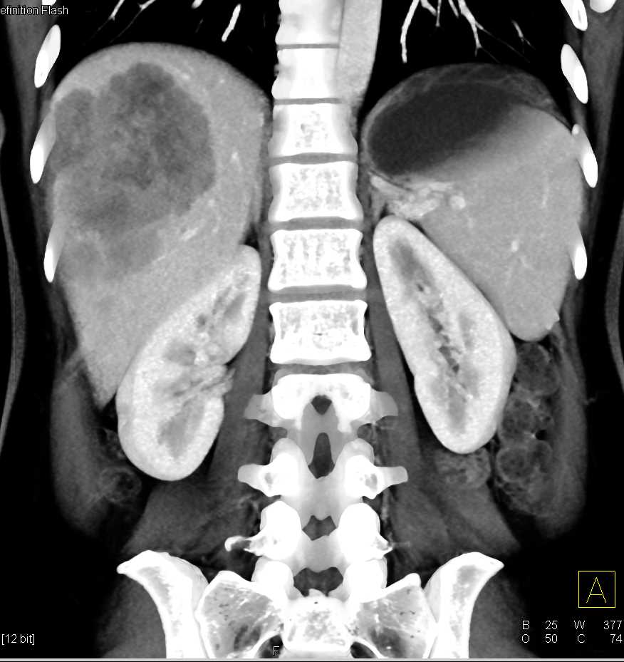 CTA Liver with a Cholangiocarcinoma - CTisus CT Scan