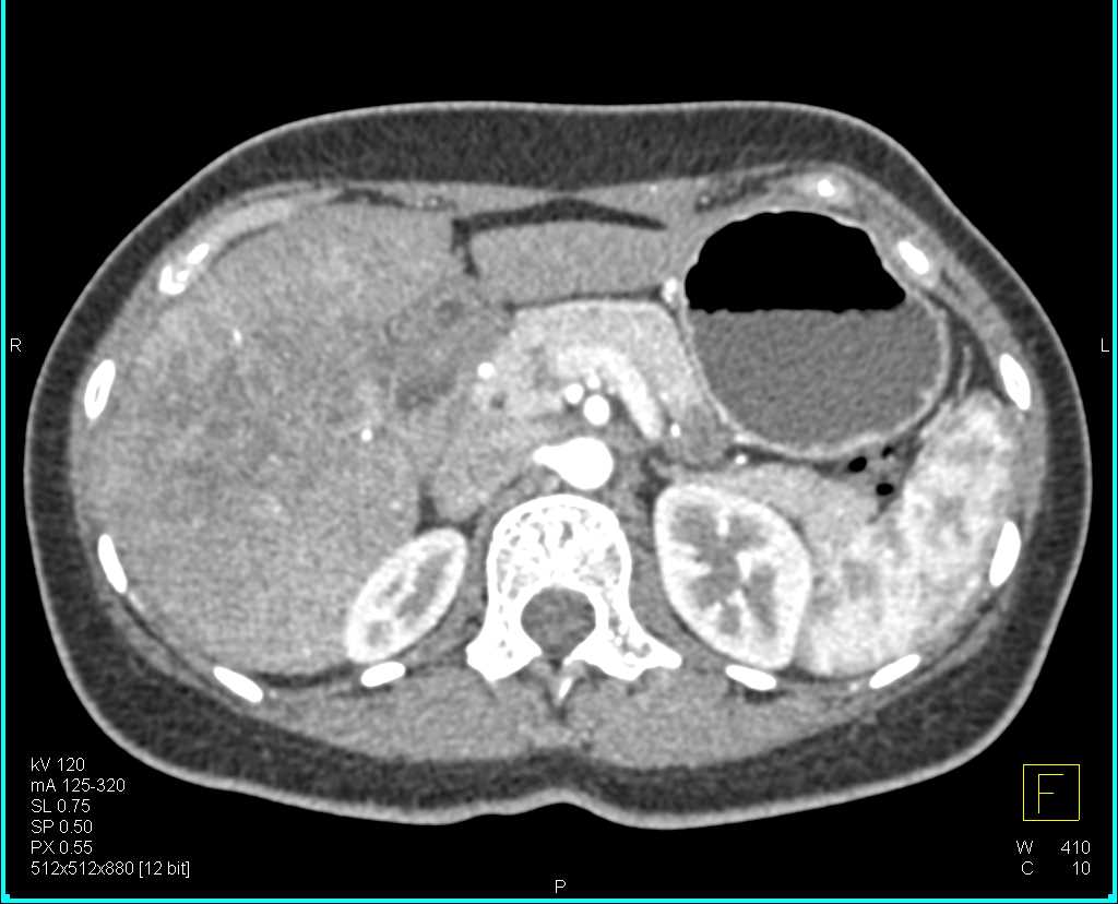 CTA Liver with a Cholangiocarcinoma - CTisus CT Scan
