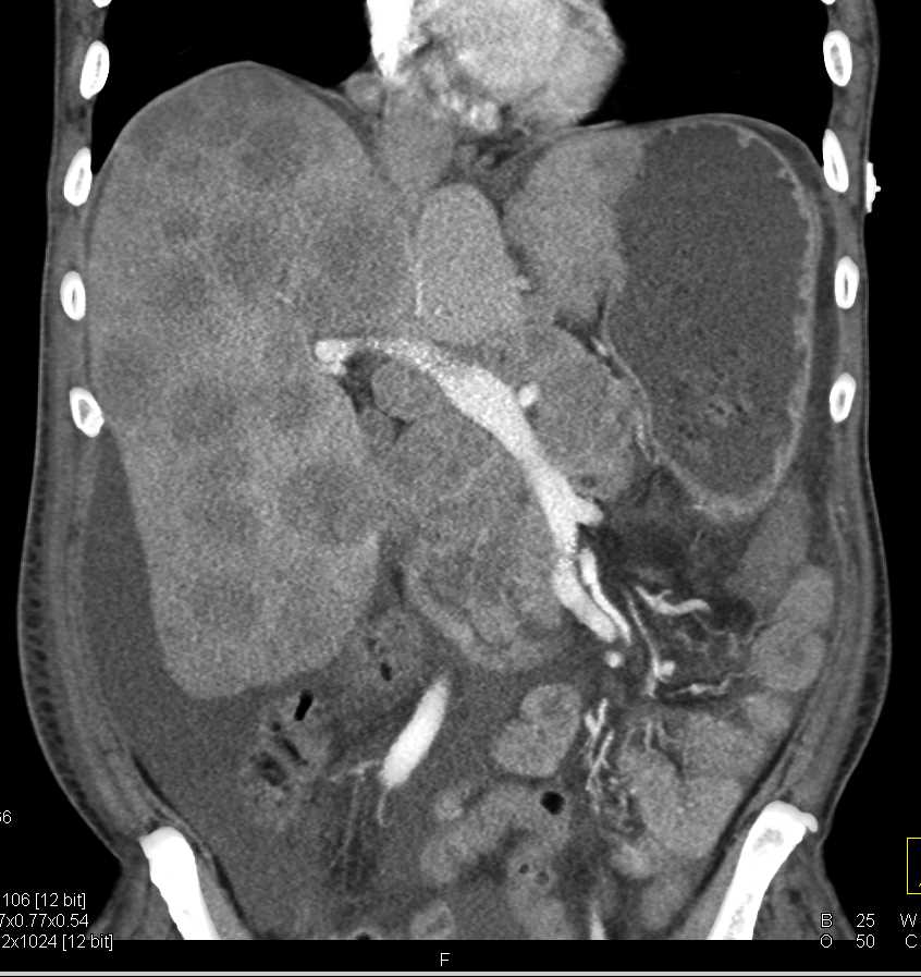 Lymphoma Involves the Liver - CTisus CT Scan