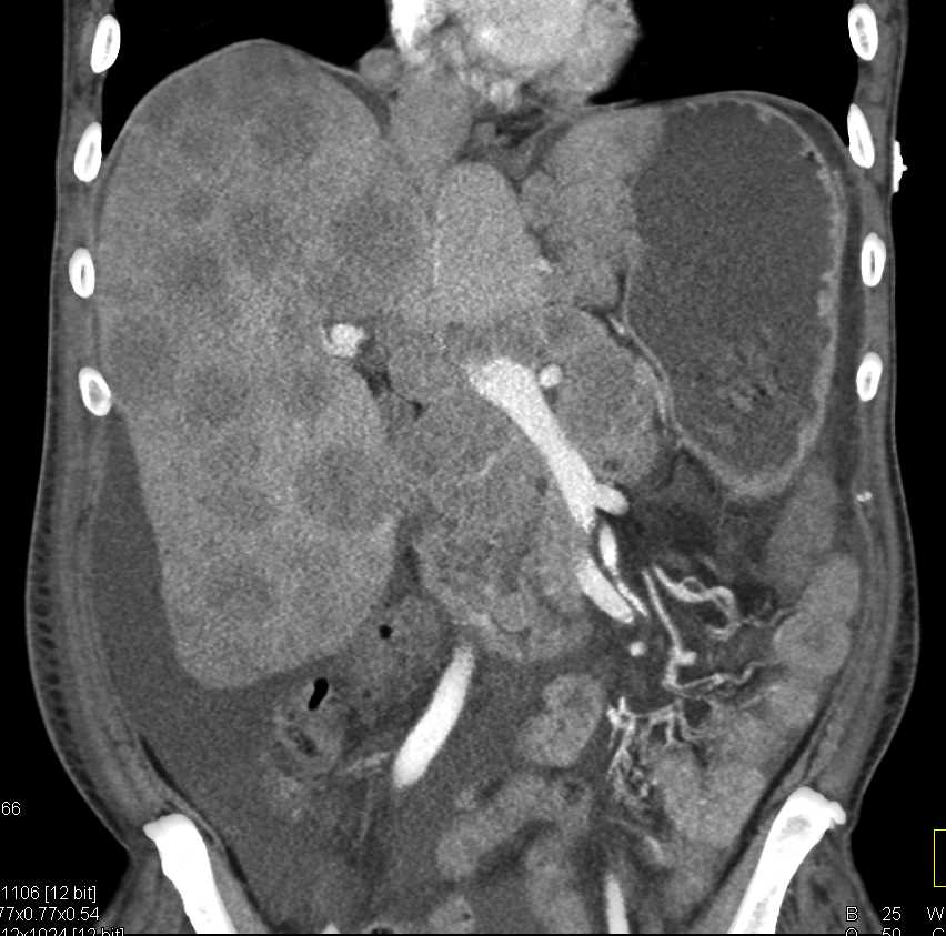 Lymphoma Involves the Liver - CTisus CT Scan