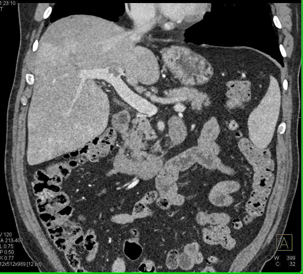 Hepatoma Invades the Stomach - CTisus CT Scan
