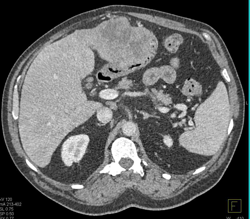 Hepatoma Invades the Stomach - CTisus CT Scan