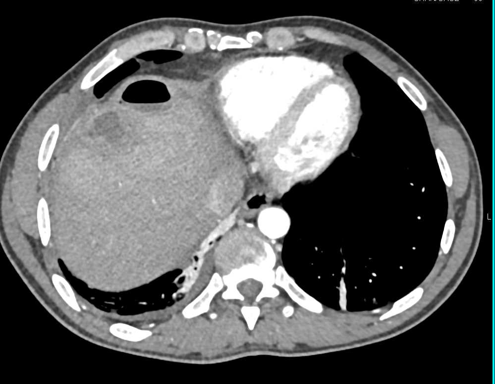 Multiple Liver Abscesses - CTisus CT Scan