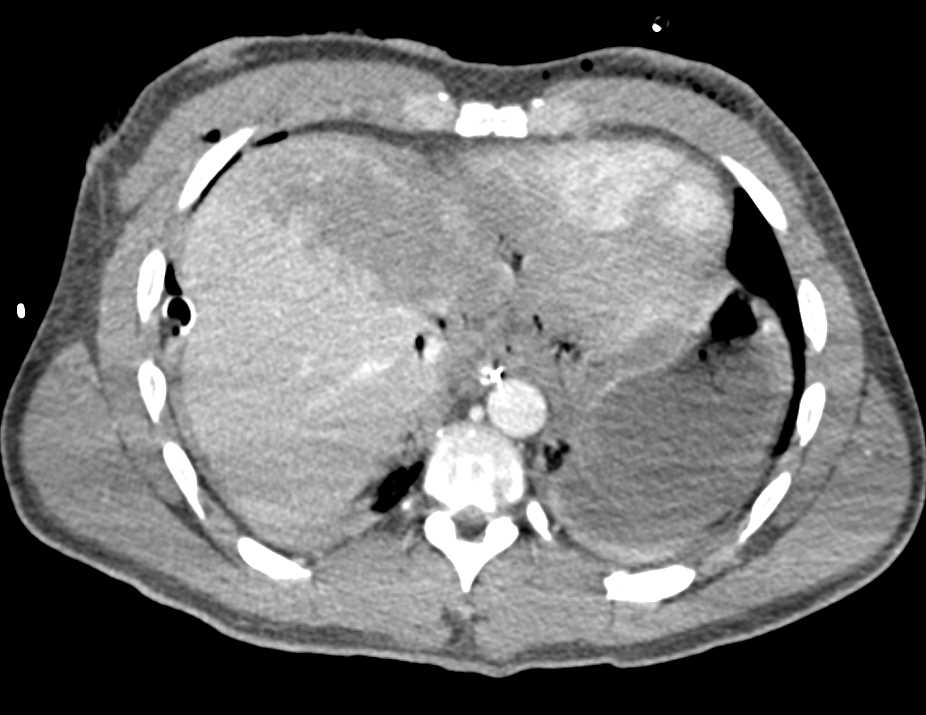 Liver Contusion - CTisus CT Scan