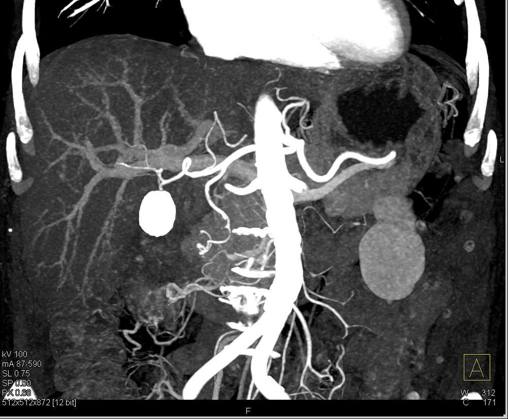 Aggressive Gallbladder Cancer - CTisus CT Scan