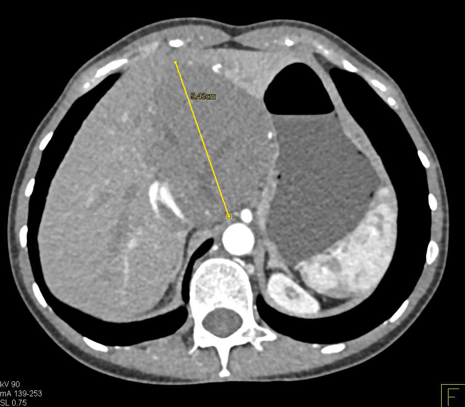 Hepatic Hemangioma - CTisus CT Scan