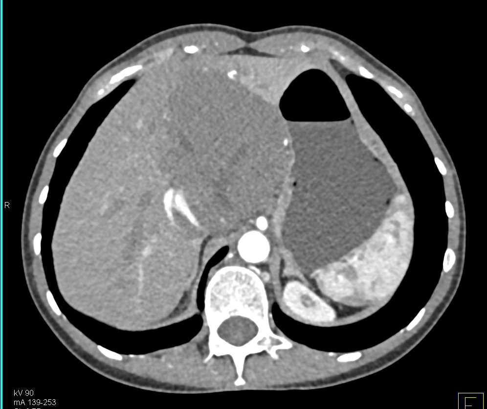 Hepatic Hemangioma - CTisus CT Scan