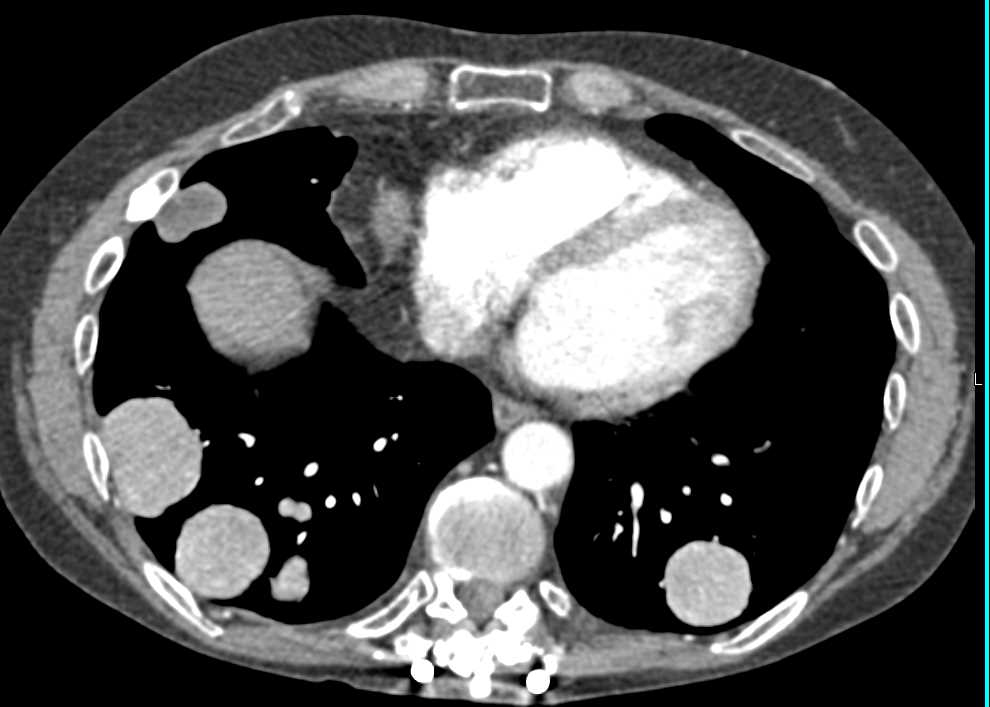 Metastatic Hepatocellular Carcinoma (Hepatoma) with Liver Metastases - CTisus CT Scan