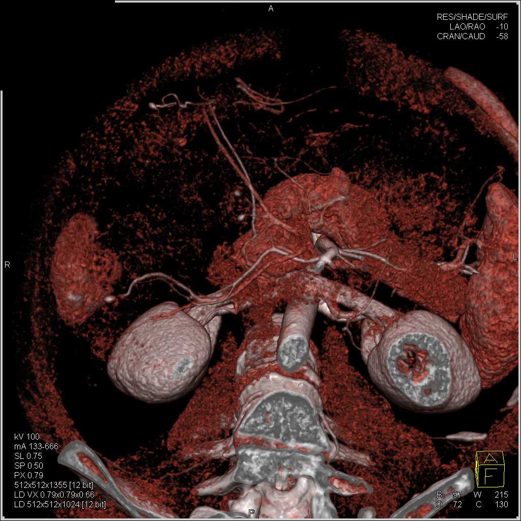 Multifocal Hepatoma in the Liver - CTisus CT Scan