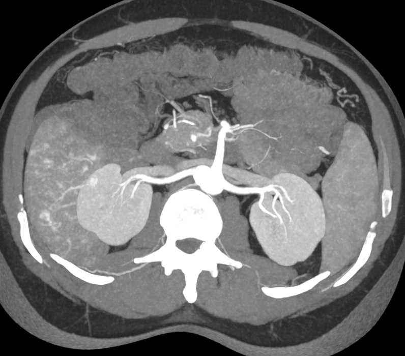Multifocal Hepatoma in the Liver - CTisus CT Scan