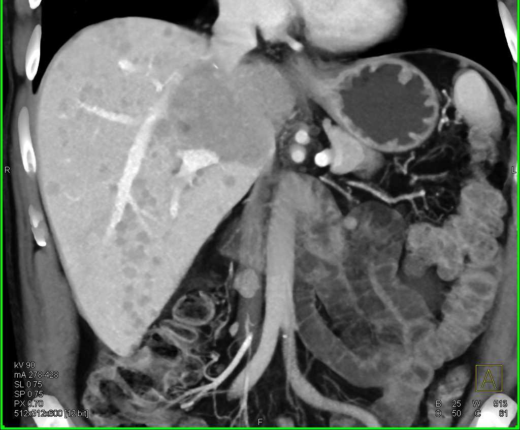 Vascular Liver Metastases from a Neuroendocrine Tumor - CTisus CT Scan
