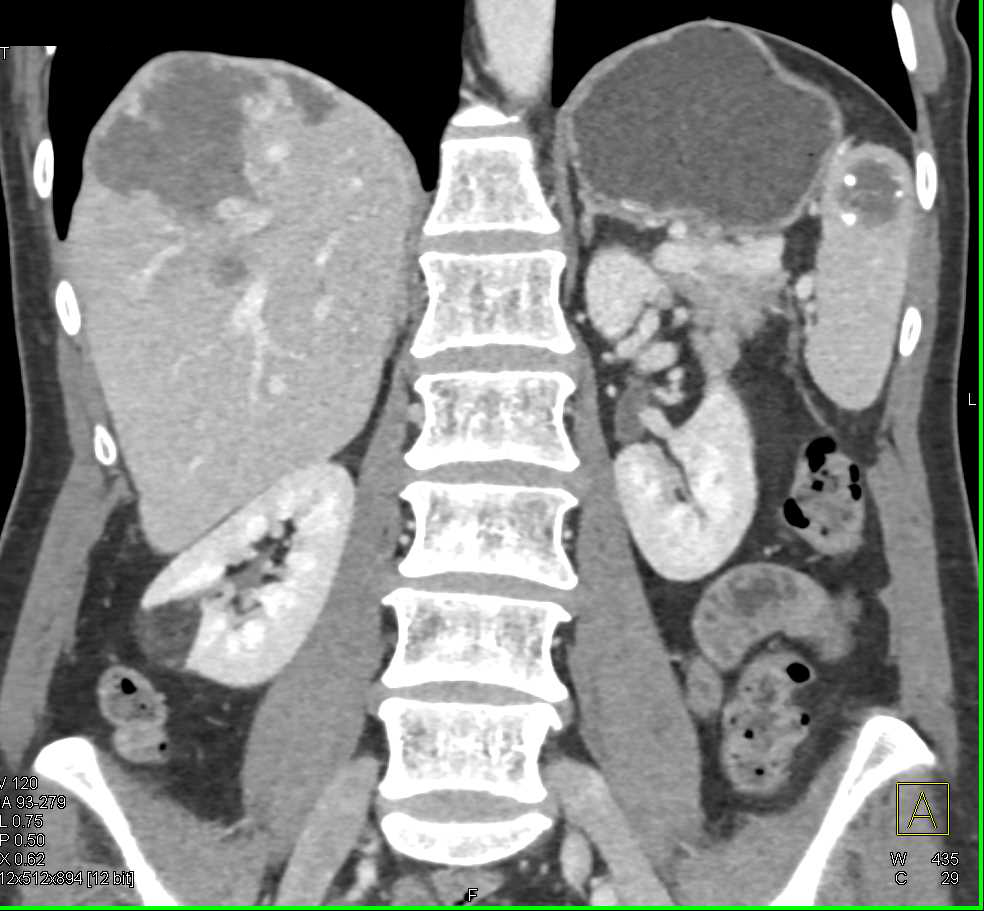 Giant Cavernous Hemangioma of the Liver - CTisus CT Scan