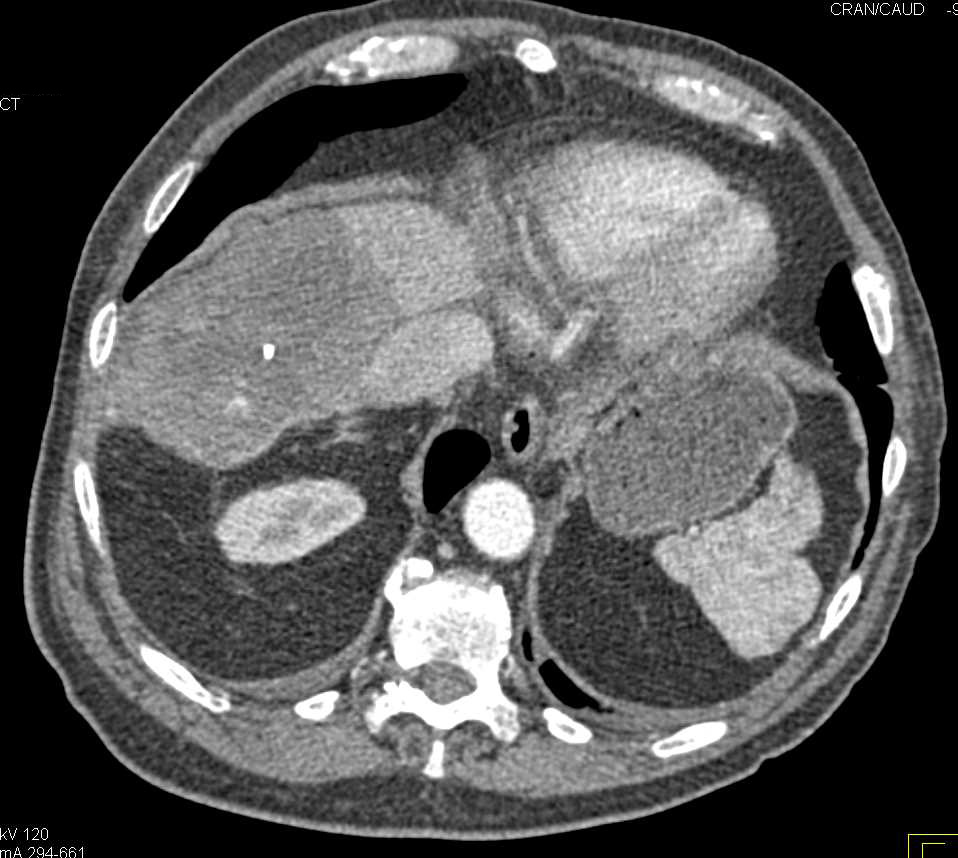 Cholangiocarcinoma Liver - CTisus CT Scan