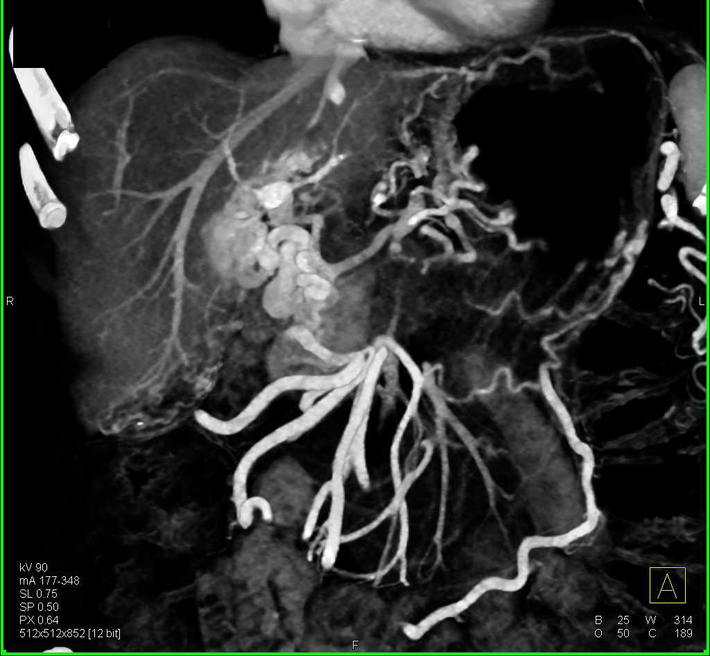 Cavernous Transformation of the Portal Vein with Collaterals - CTisus CT Scan