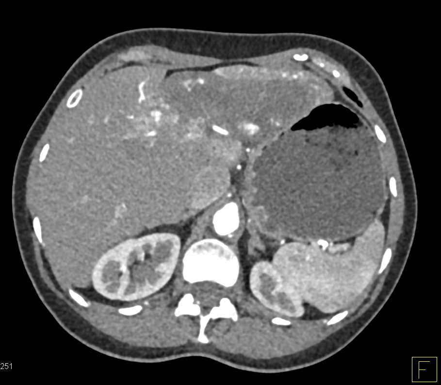 Hepatic Hemangioma - CTisus CT Scan