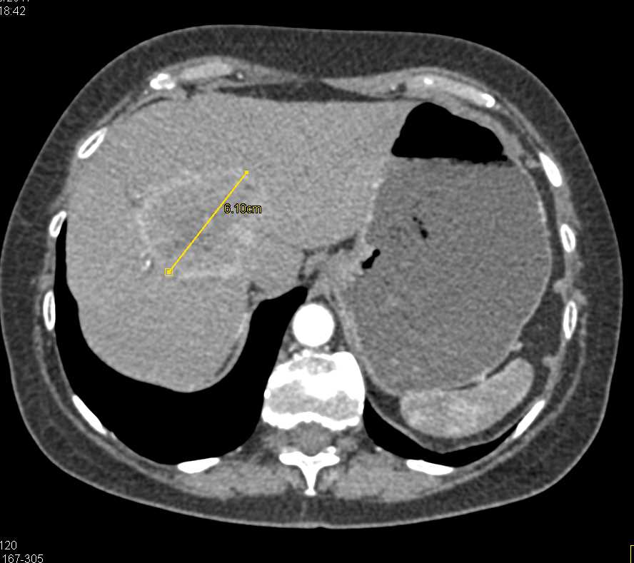 Cholangiocarcinoma of the Liver - CTisus CT Scan