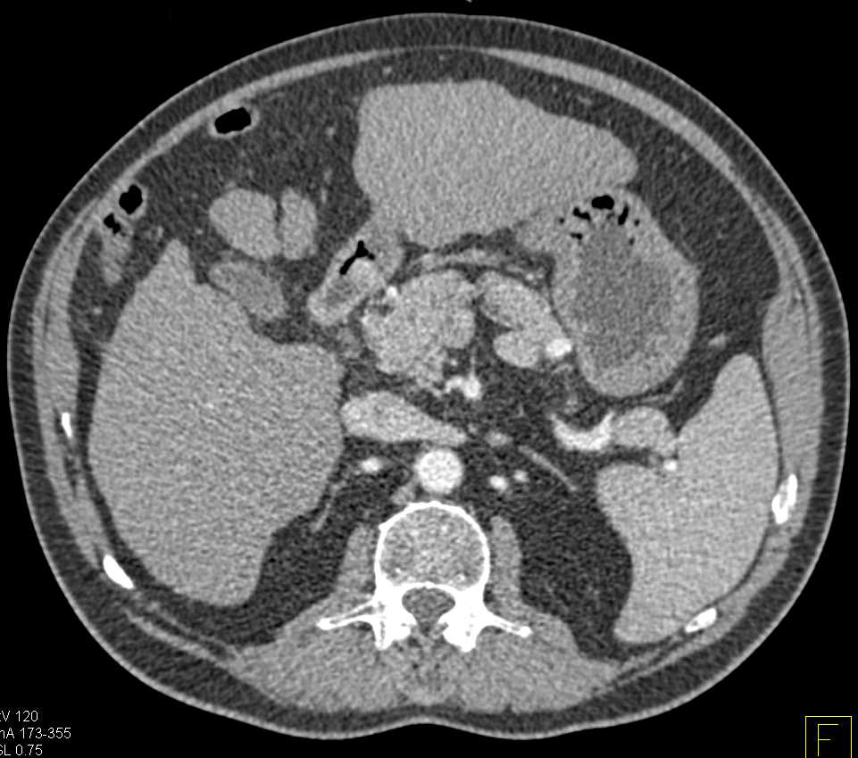 Liver Cirrhosis CT Scan