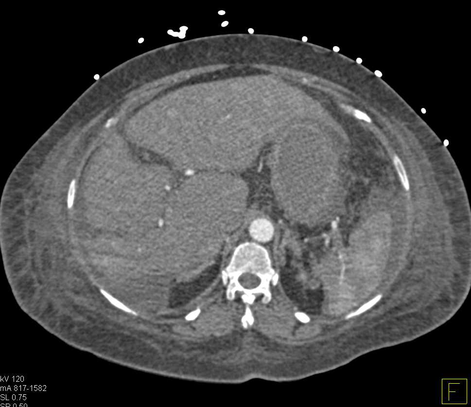 Neuroendocrine Metastases to the Liver - CTisus CT Scan