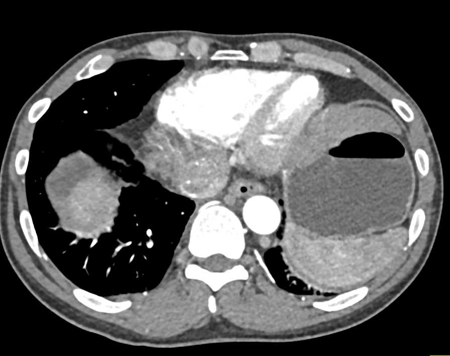 Hepatocellular Carcinoma (Hepatoma) Infiltrates Liver and Extends into Inferior Vena Cava (IVC) and Right Atrium - CTisus CT Scan