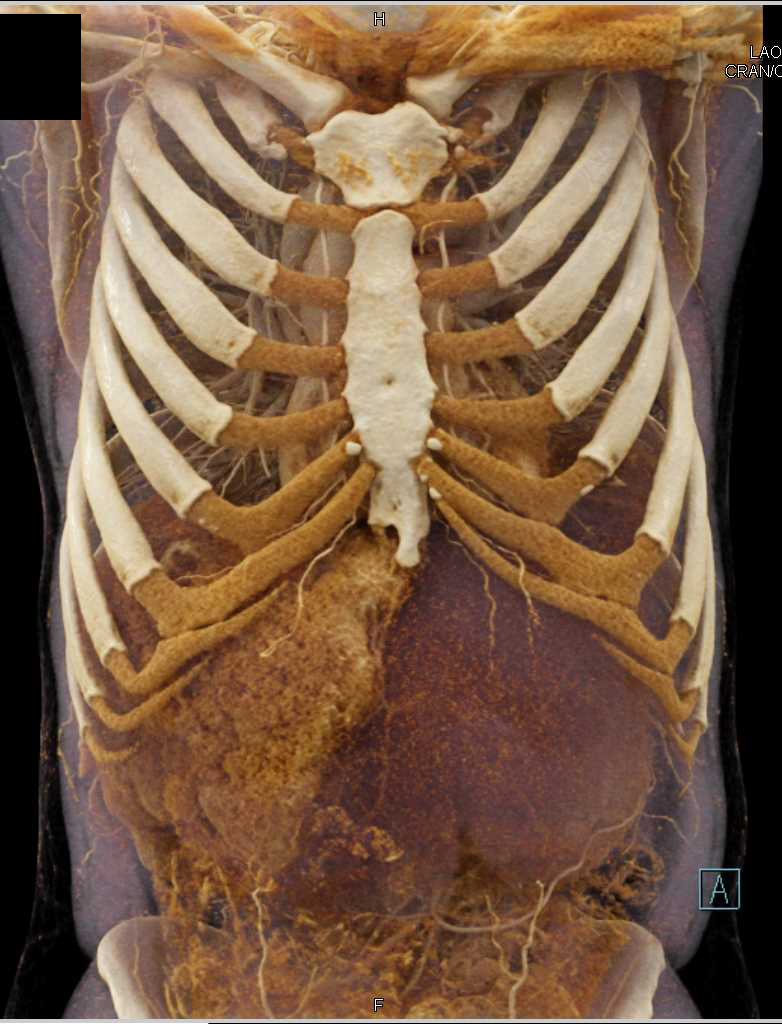 Hepatocellular Carcinoma (Hepatoma) with Cinematic Rendering - CTisus CT Scan