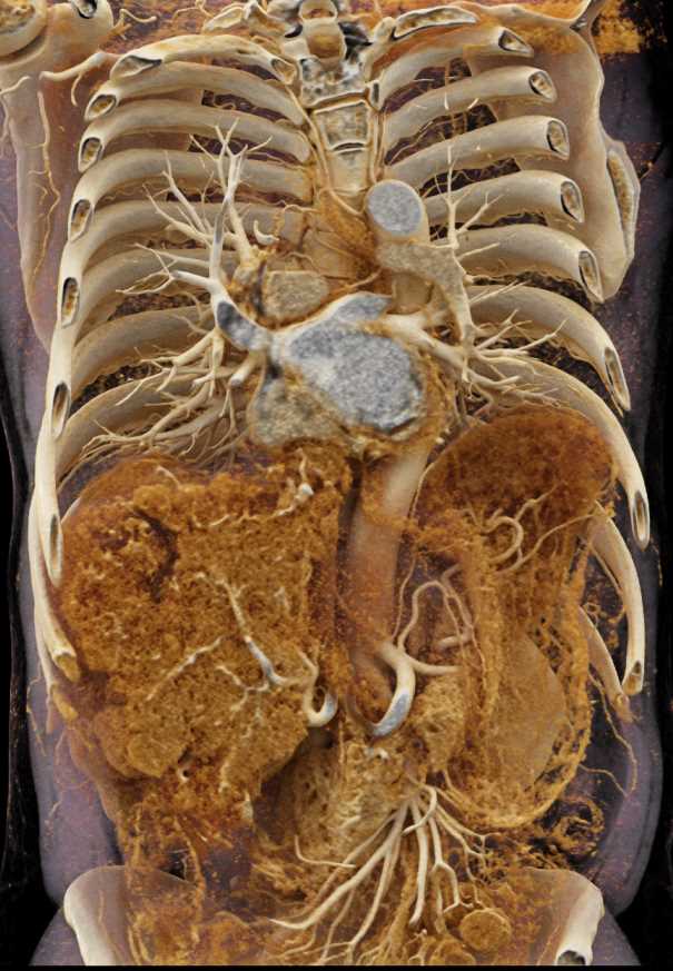 Hepatocellular Carcinoma (Hepatoma) with Cinematic Rendering - CTisus CT Scan