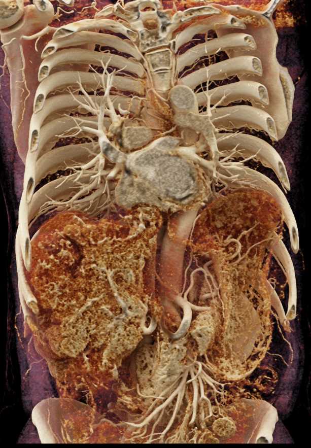 Hepatocellular Carcinoma (Hepatoma) with Cinematic Rendering and Texture Mapping - CTisus CT Scan