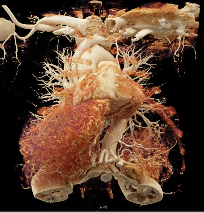 Hepatocellular Carcinoma (Hepatoma) Infiltrates the Liver with Cinematic Rendering - CTisus CT Scan