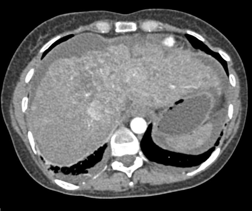 Multifocal Hepatocellular Carcinoma (Hepatoma) in the Liver - CTisus CT Scan