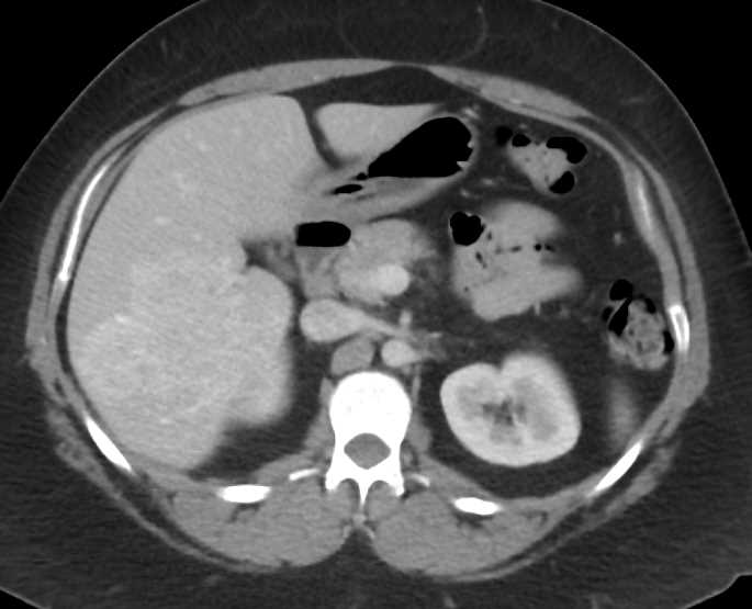 Hepatic Adenoma - CTisus CT Scan