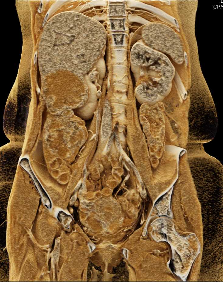 Hepatocellular Carcinoma (Hepatoma) with Cinematic Rendering - CTisus CT Scan