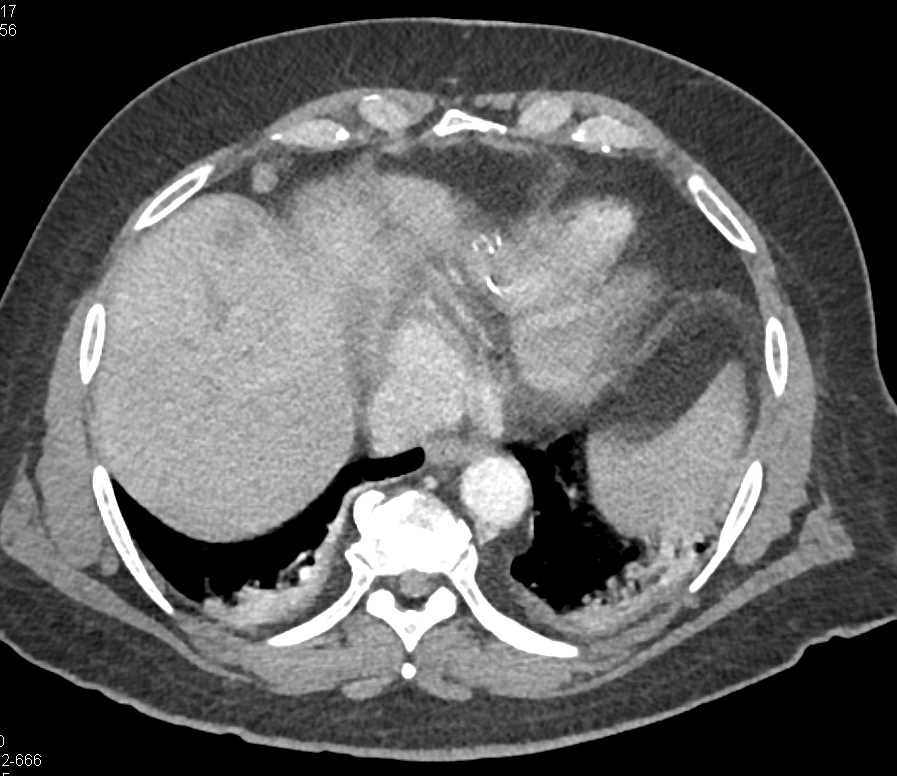 Gallbladder Cancer with Liver Metastases - CTisus CT Scan