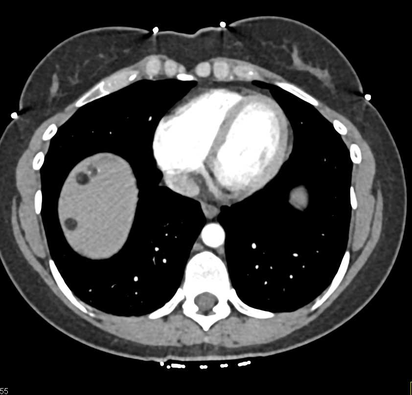 Multiple Hepatic Angiomyolipomas - CTisus CT Scan