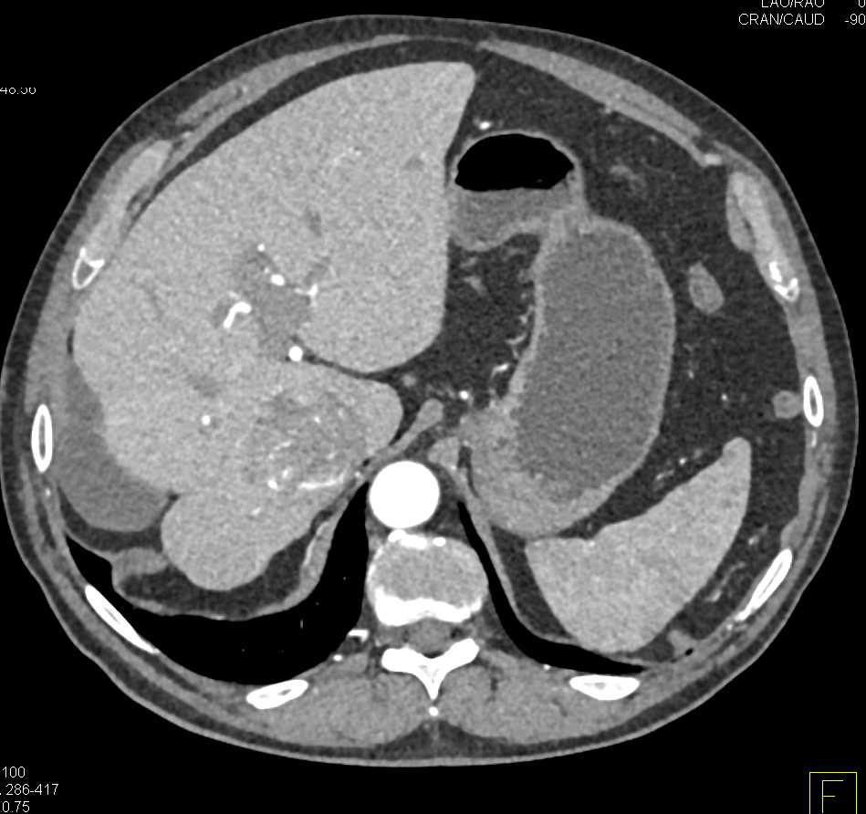 Hepatocellular Carcinoma (Hepatoma) with Neovascularity - CTisus CT Scan