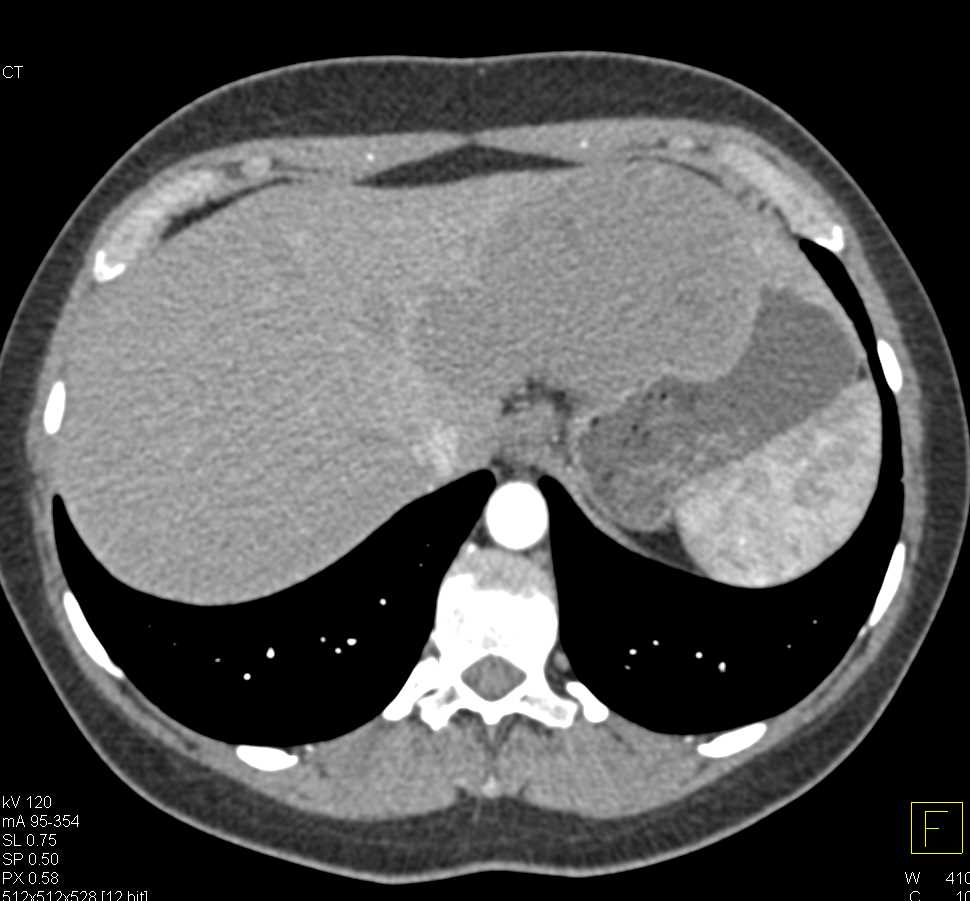 Giant Cavernous hemangioma of the Liver - CTisus CT Scan