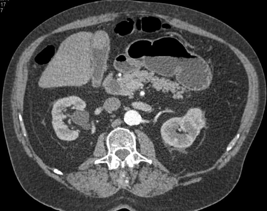 Polypoid Mass in Gallbladder was Cancer - CTisus CT Scan