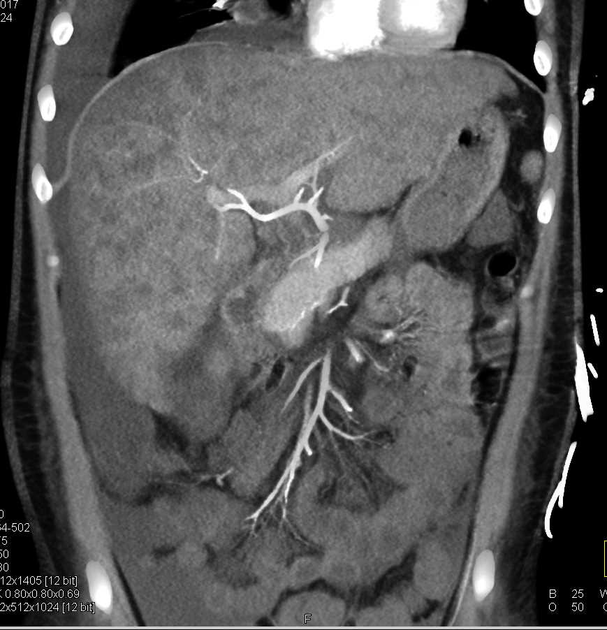 Multifocal Hepatocellular Carcinoma (Hepatoma) - CTisus CT Scan