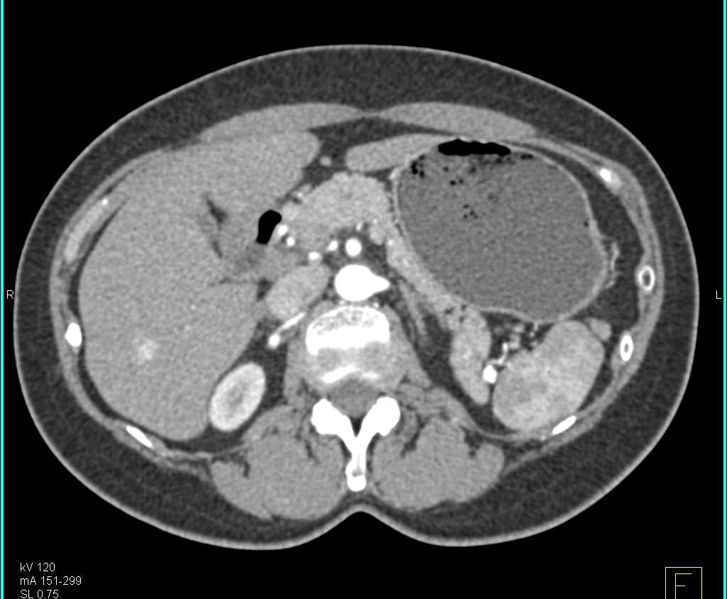 Hepatic Hemangioma - CTisus CT Scan