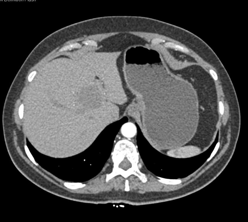 Hepatic Cyst - CTisus CT Scan