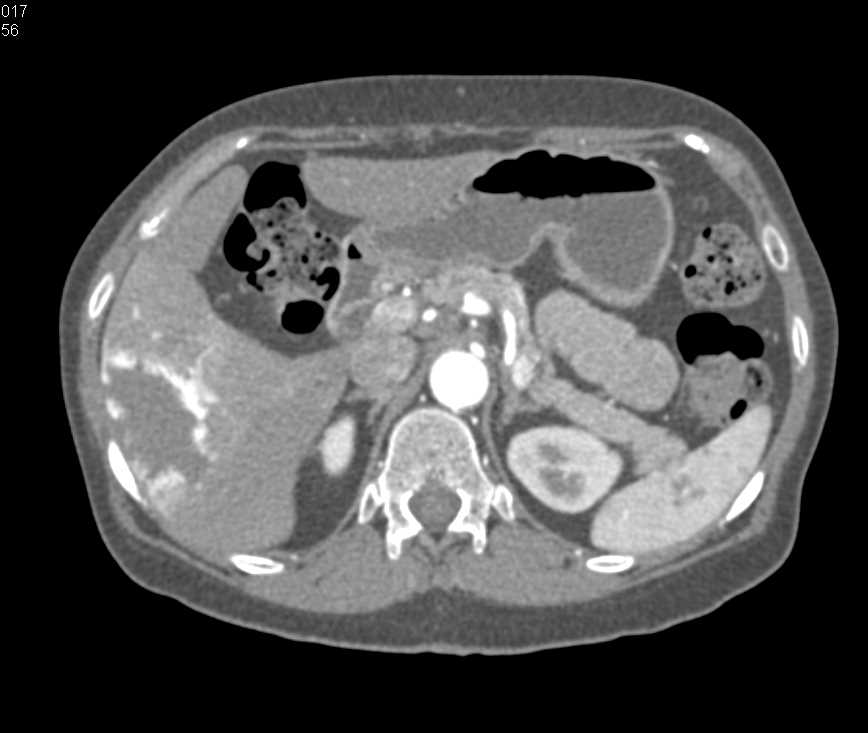 Hepatic Hemangioma - CTisus CT Scan